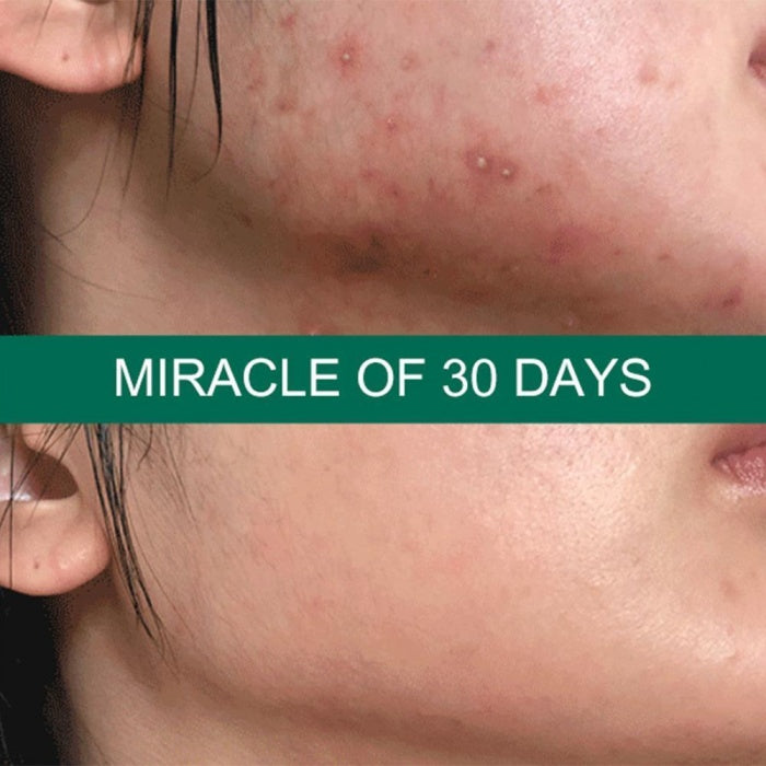 Some By Mi - AHA, BHA, PHA 30 Days Miracle Serum 50ml – Ορός Αναγέννησης και Εξυγίανσης για το Δέρμα