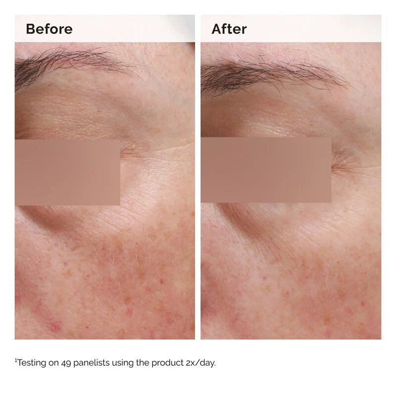 The Ordinary Niacinamide 5% Face & Body Emulsion Γαλάκτωμα για Πρόσωπο & Σώμα κατά των Κηλίδων, 100ml