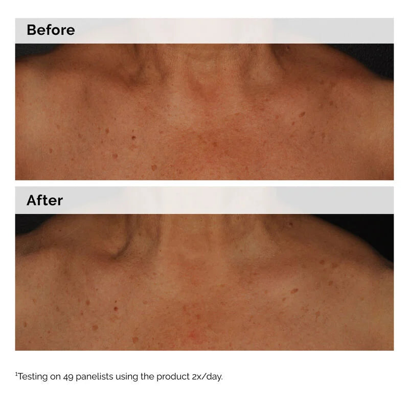 The Ordinary Niacinamide 5% Face & Body Emulsion Γαλάκτωμα για Πρόσωπο & Σώμα κατά των Κηλίδων, 100ml