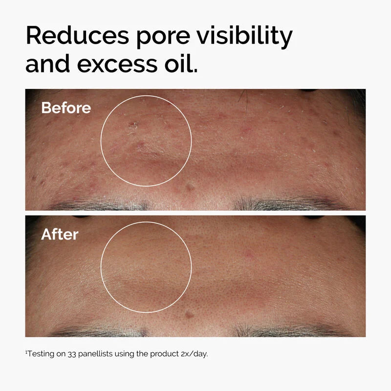 The Ordinary Niacinamide 10% & Zinc 1% Ορός Προσώπου κατά των Ατελειών, 30ml