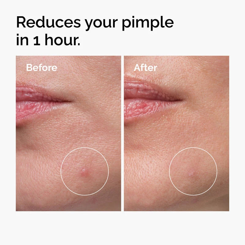 The Ordinary Sulfur 10% Powder to Cream Κρέμα Προσώπου κατά των Ατελειών & της Ακμής 5gr